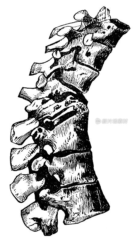 人类脊柱后凸(驼背)的医学插图- 19世纪